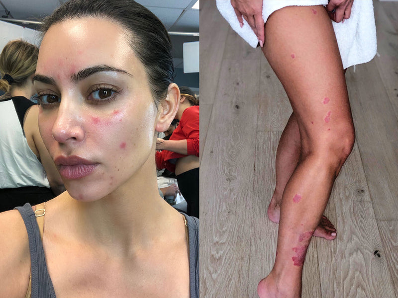 Kim Shares Her Psoriasis Journey